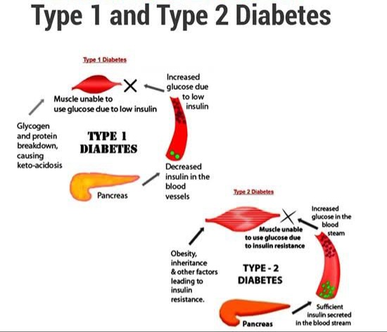 Special Considerations for Different Types of Diabetes