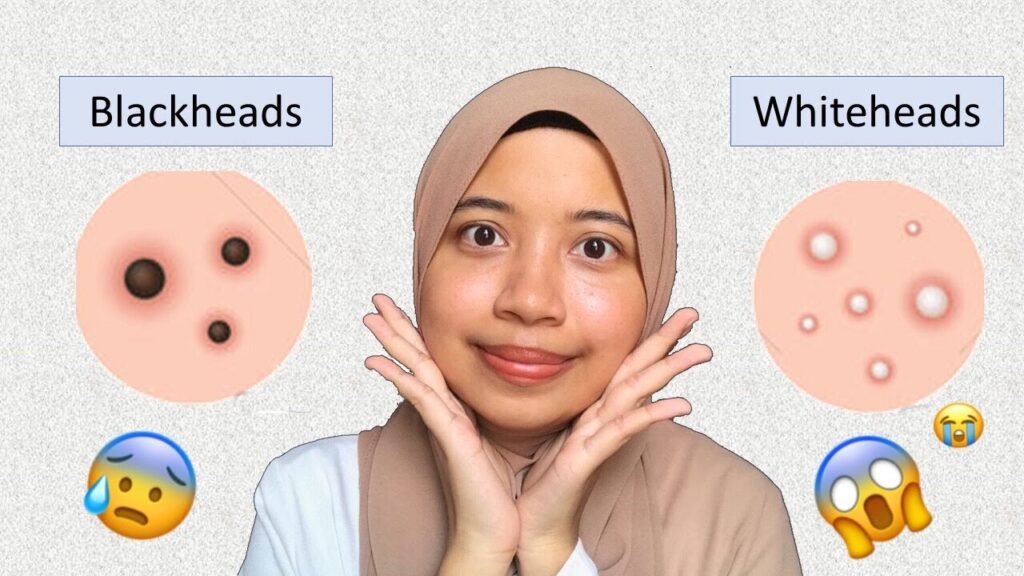 Differences Between Blackheads and Whiteheads