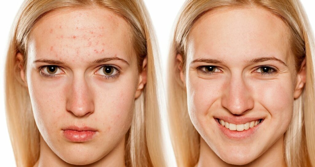 How Rosehip Seed Oil Helps in Fading Acne Scars